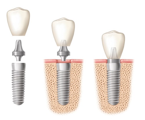 1.dental