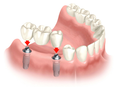 3.denta