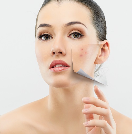 Pingback:How To Get Rid of Acne Scars | Cosmetic Creams