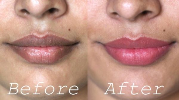 Home Remedies For Dark Upper Lips